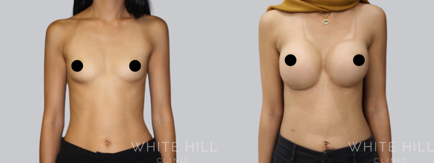 Breast Enhancement Sydney White Hill Clinic