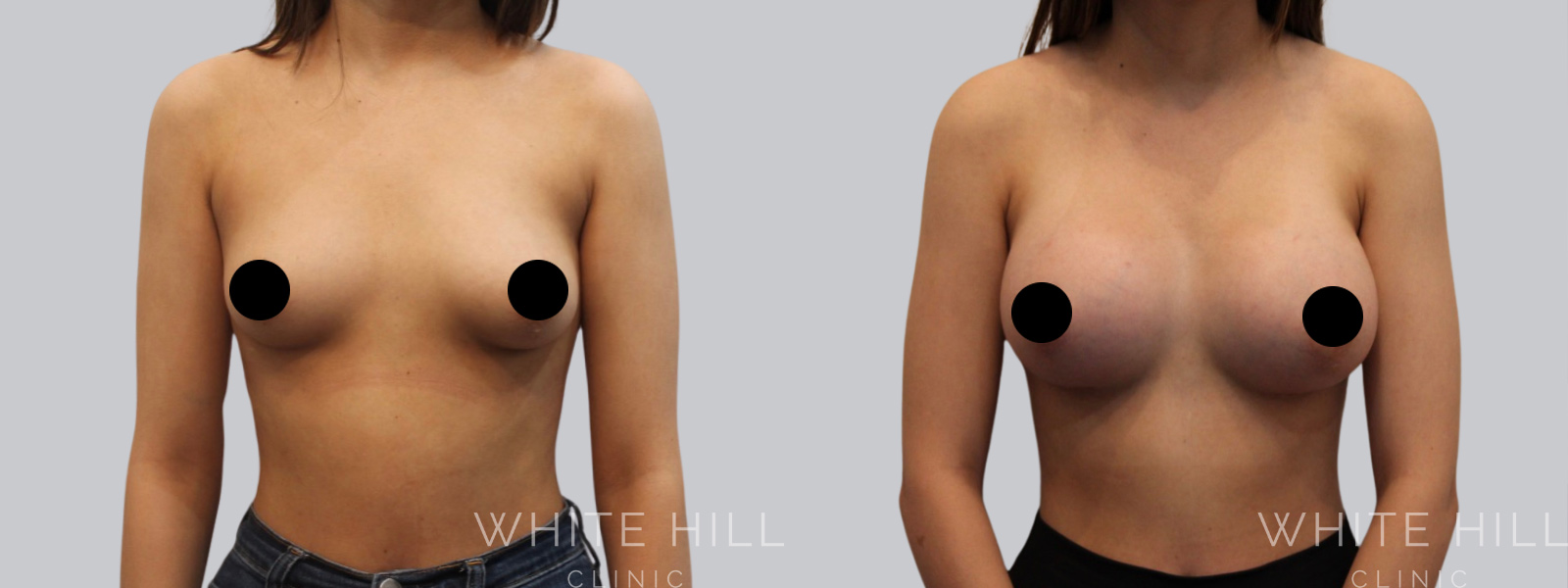 Breast Enhancement Sydney White Hill Clinic