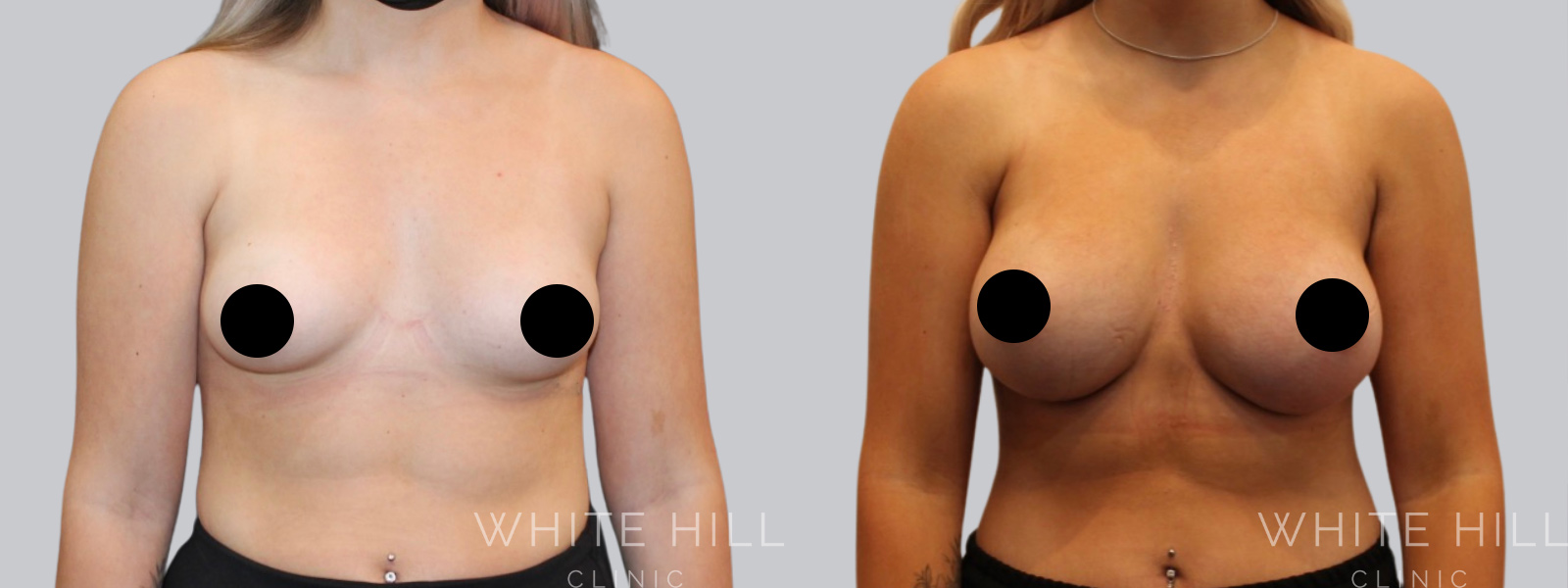 Breast Enhancement Sydney White Hill Clinic