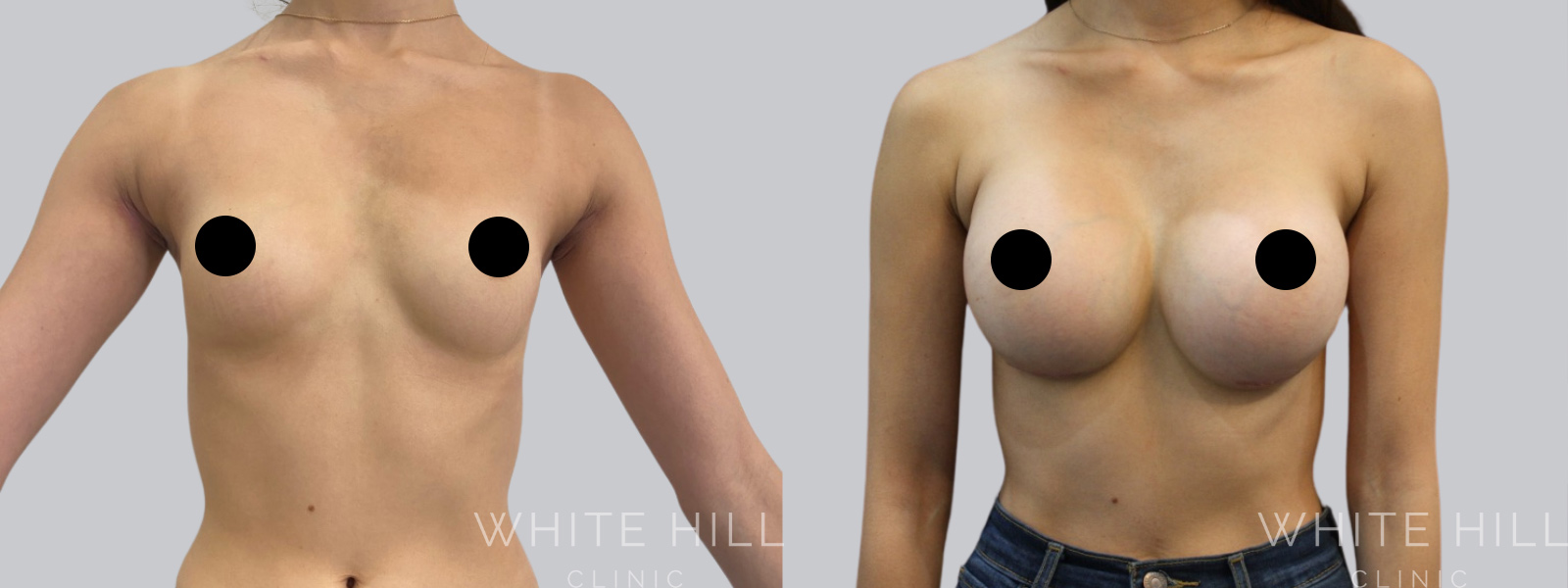 Breast Enhancement Sydney White Hill Clinic