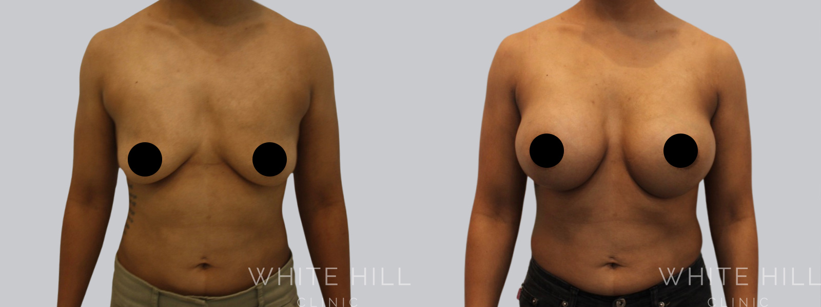 Breast Enhancement Sydney White Hill Clinic