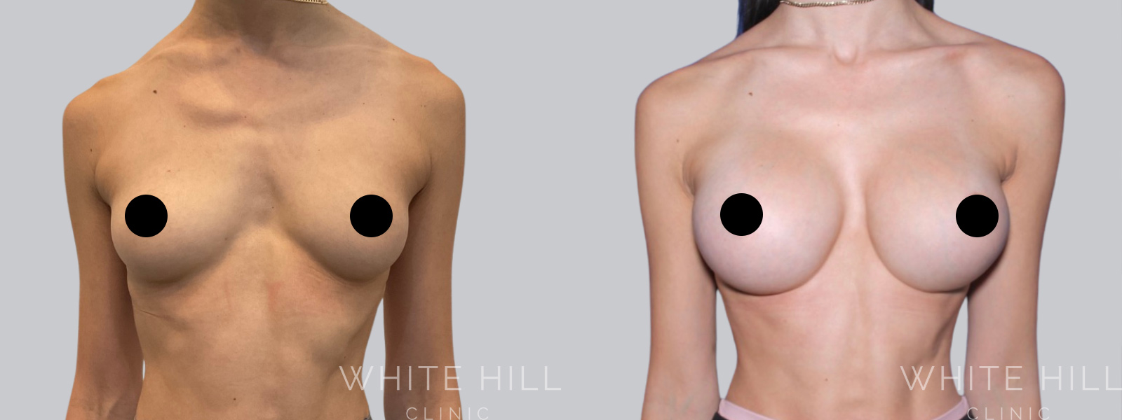 Breast Enhancement Sydney White Hill Clinic