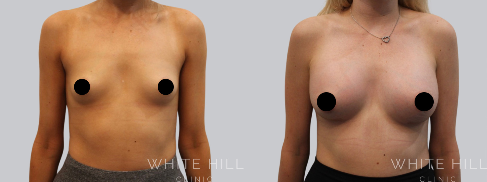 Breast Enhancement Sydney White Hill Clinic