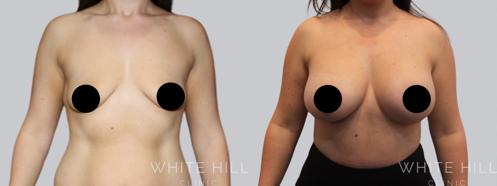 Breast Enhancement Sydney White Hill Clinic