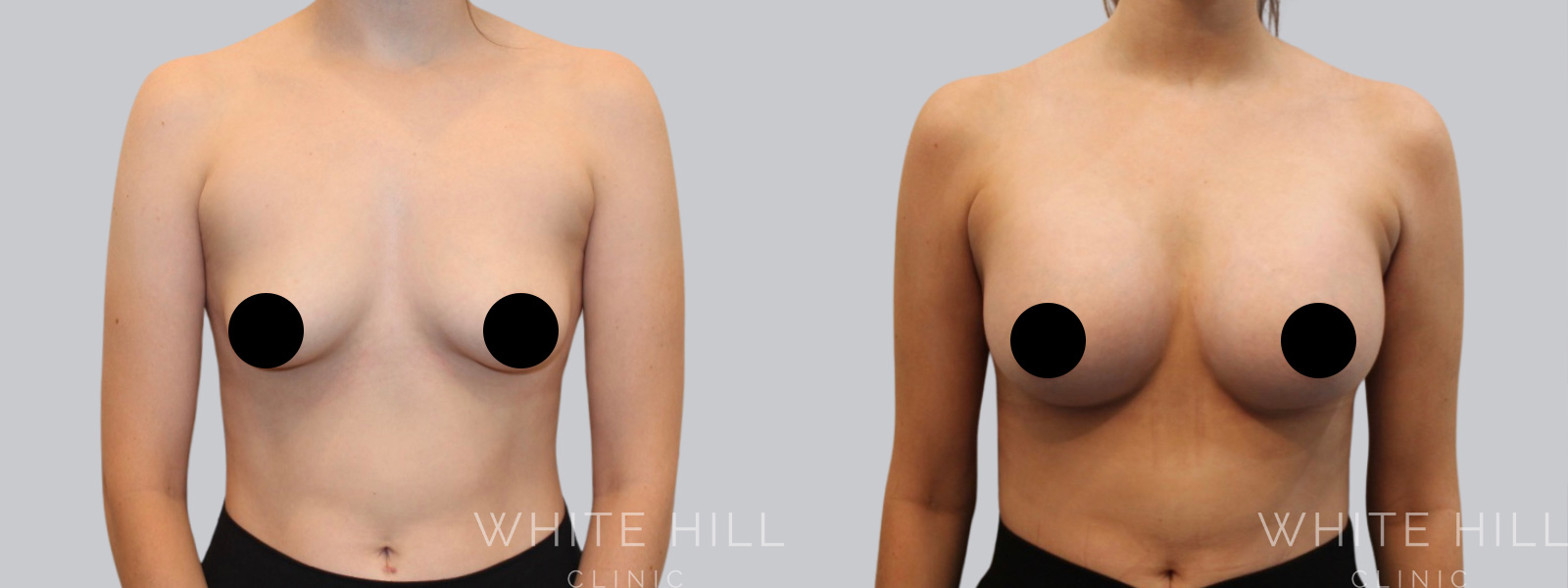 Breast Enhancement Sydney White Hill Clinic