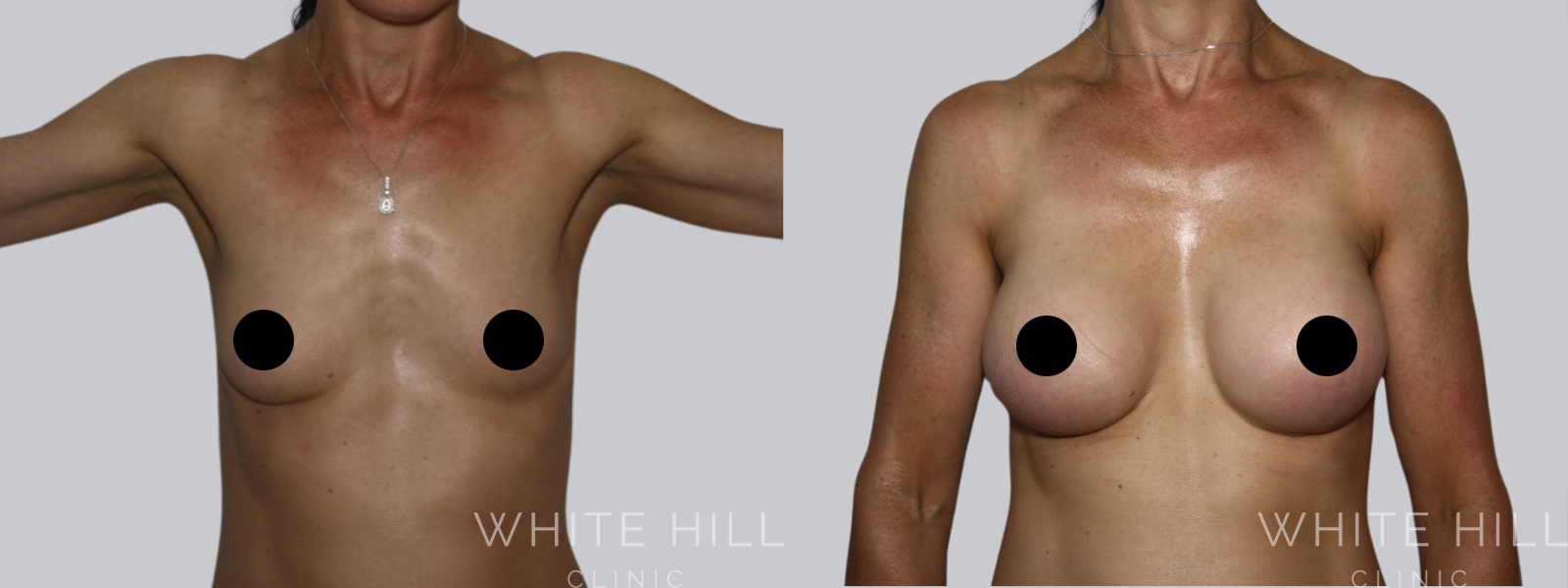 Breast Enhancement Sydney White Hill Clinic