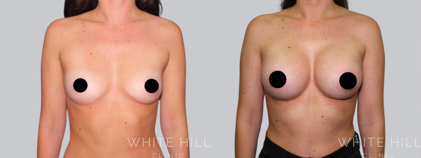 Breast Enhancement Sydney White Hill Clinic