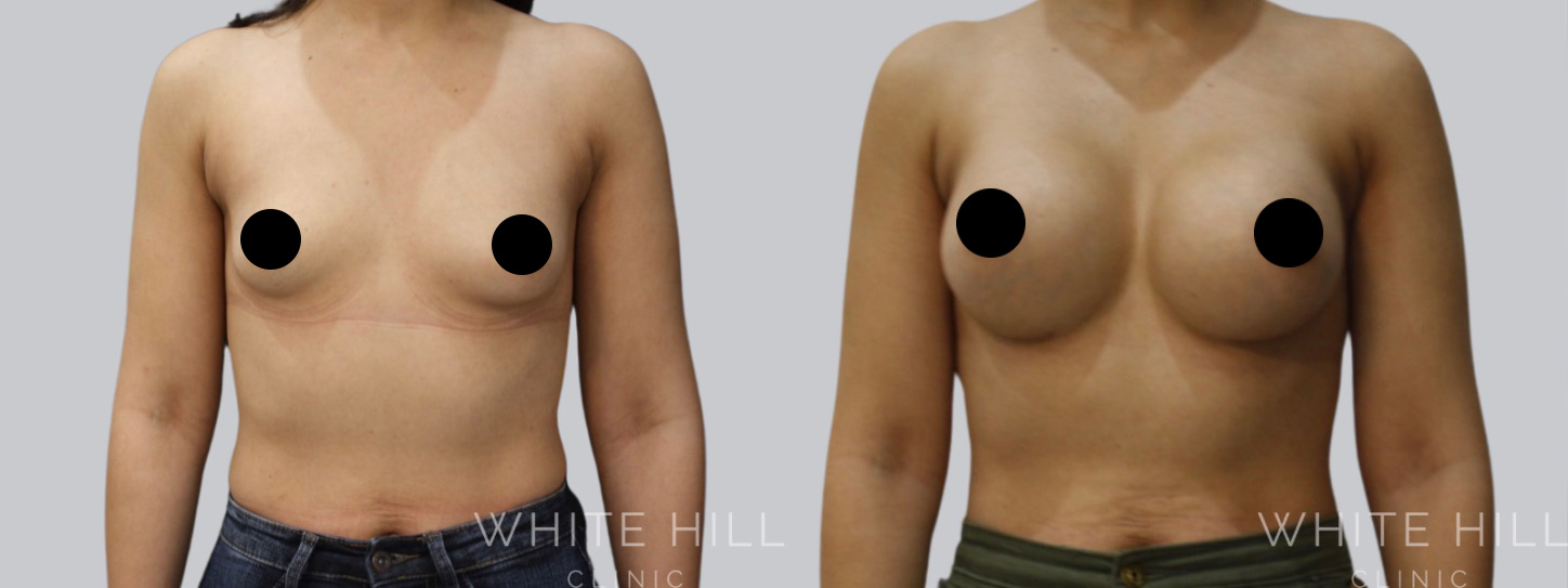 Breast Enhancement Sydney White Hill Clinic