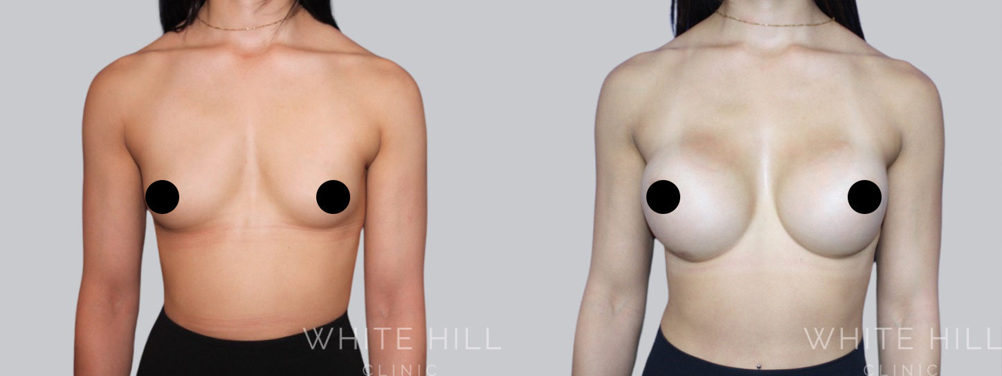 Breast Enhancement Sydney White Hill Clinic