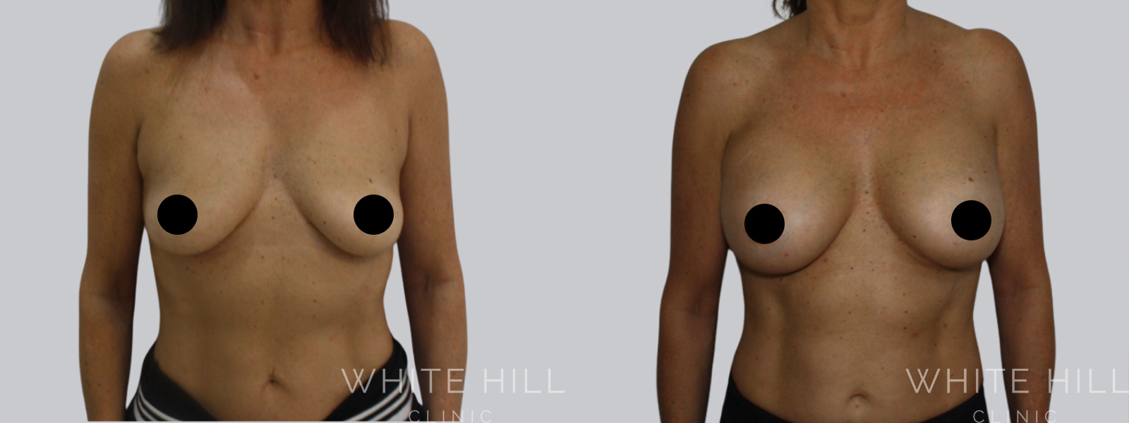 Breast Enhancement Sydney White Hill Clinic