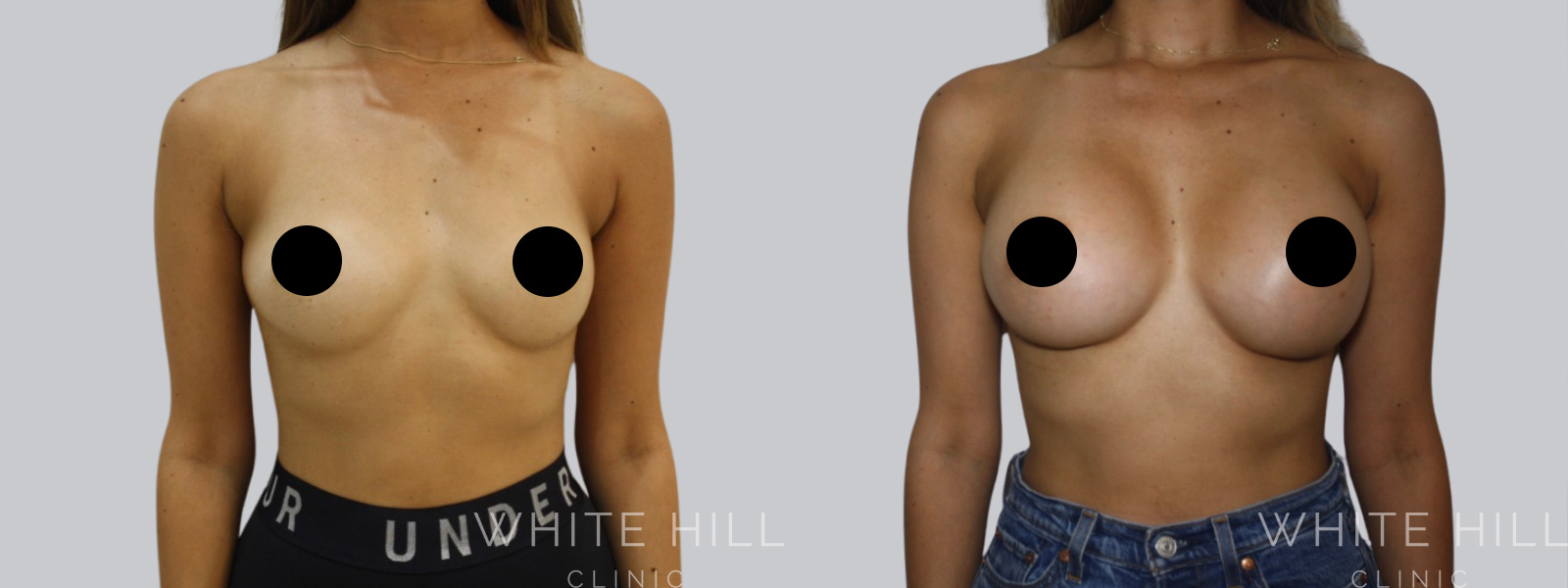 Breast Enhancement Sydney White Hill Clinic