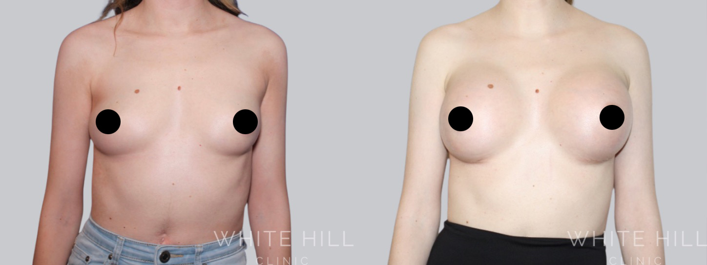 Breast Enhancement Sydney White Hill Clinic