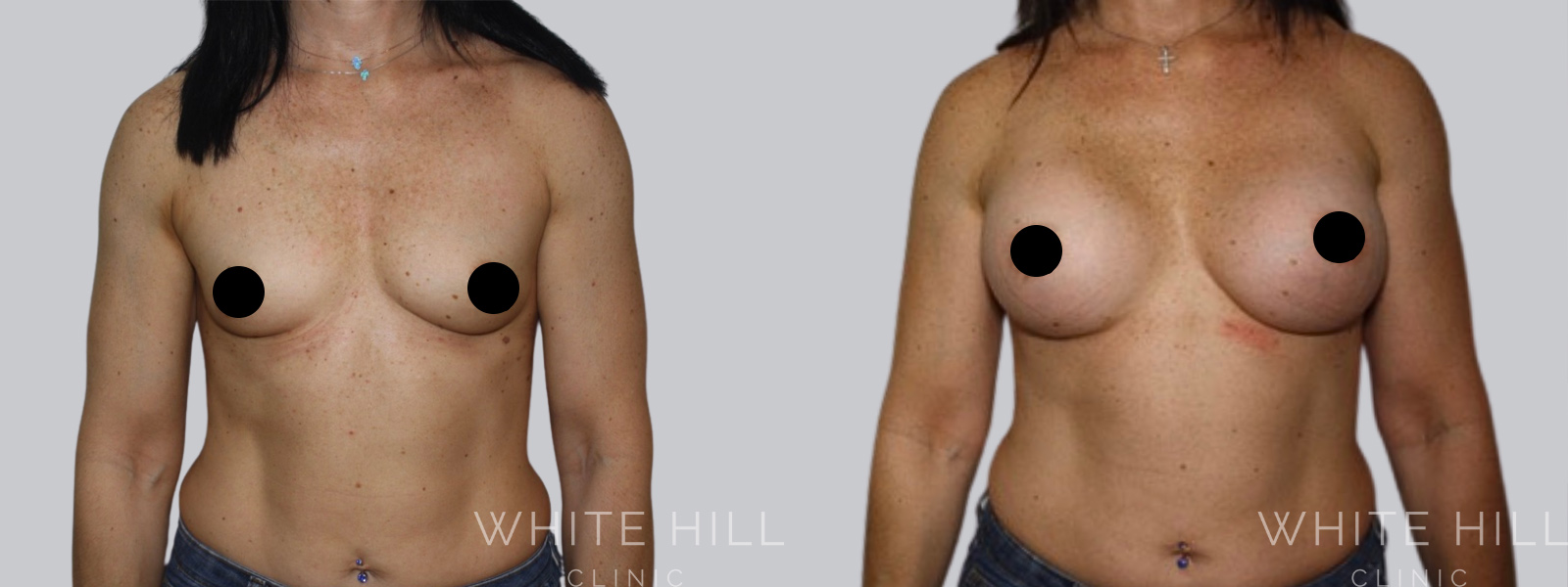 Breast Enhancement Sydney White Hill Clinic