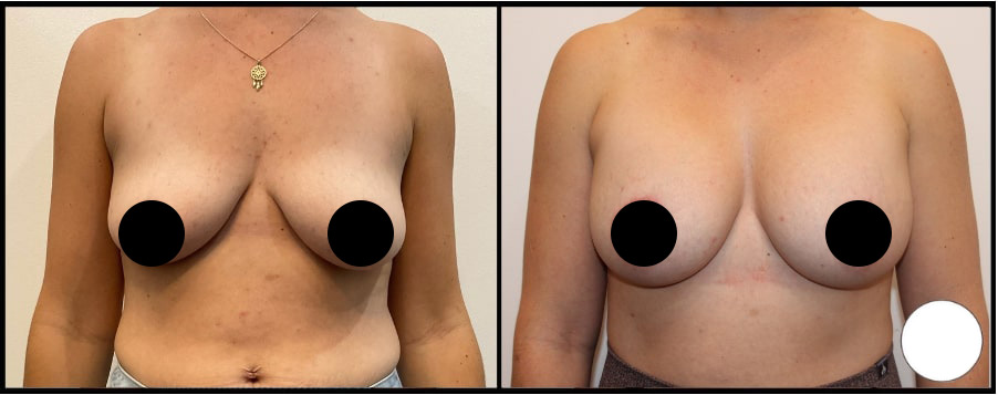 Breast Lift Before & Afters