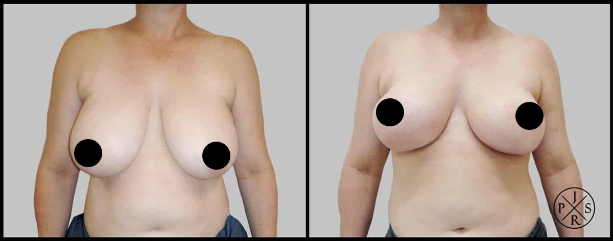 Breast Reduction Sydney - White Hill Clinic