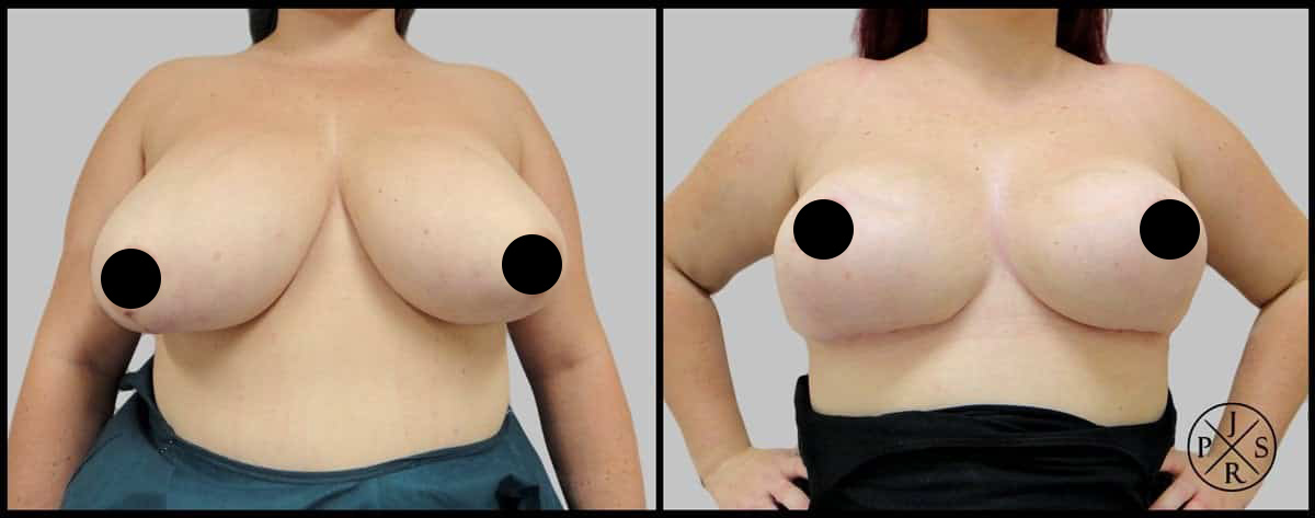 Breast-Reduction-Before-After-4