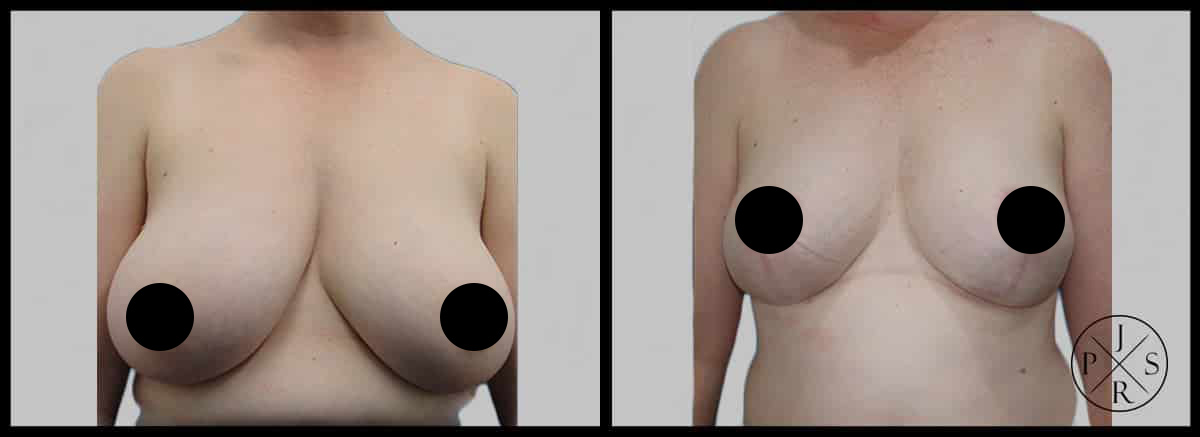 Breast-Reduction-Before-After-7