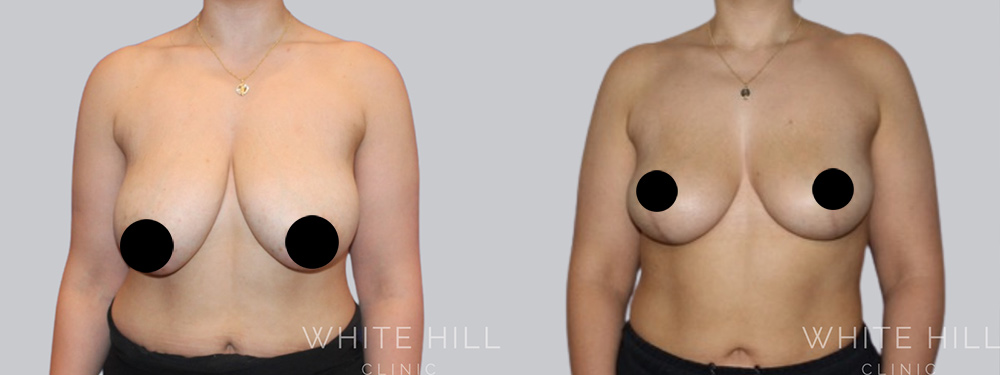 Breast Reduction and Lift Before and After Surgery Sydney