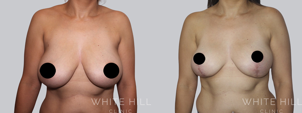 Breast Reduction and Lift Before and After Surgery Sydney