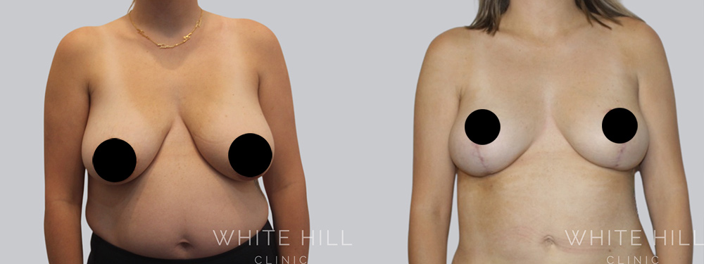 Breast Reduction and Lift Before and After Surgery Sydney