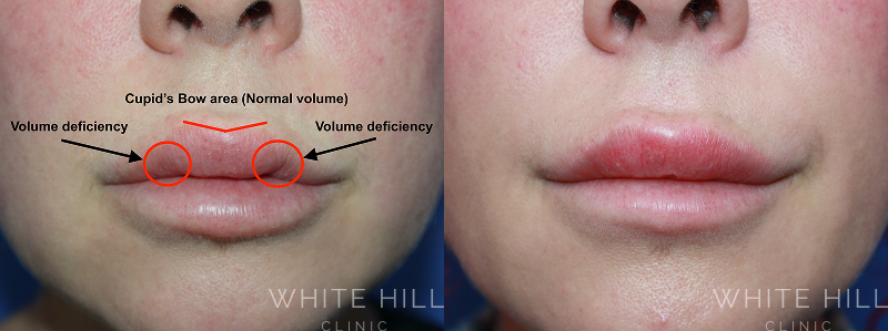 Lip Enhancement Before and After Sydney