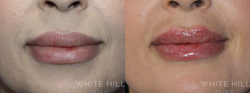 Lip Enhancement Before and After Sydney