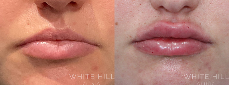 Lip Enhancement Before and After Sydney