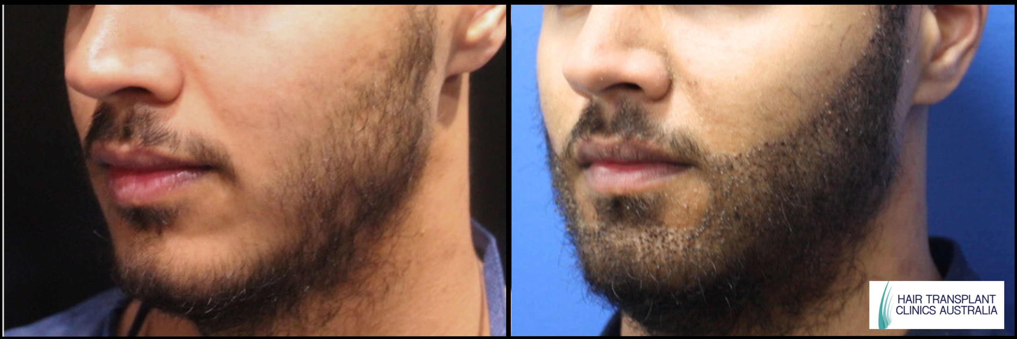 Beard FUE Before & After Image